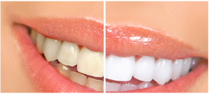 blanchiment-dents
