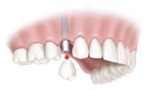 implant-dentaire