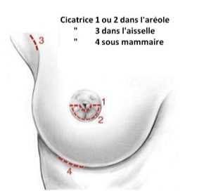 incisions-augmentation-mammaire