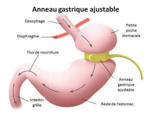 Anneau gastrique ajustable