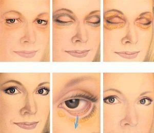 Blepharoplasty