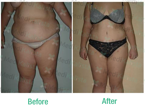 liposuccion