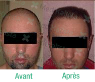 greffe de cheveux FUE greffe de cheveux FUE