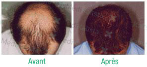 greffe de cheveux FUE greffe de cheveux FUE