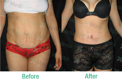 tummy tuck tummy tuck