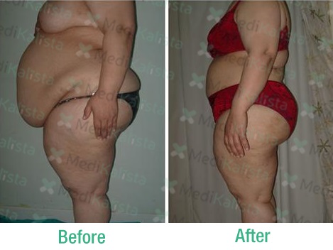 tummy tuck tummy tuck
