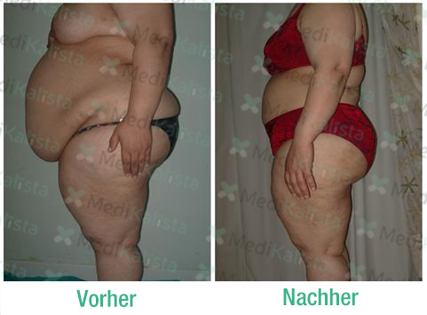 liposculpture