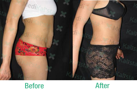 tummy tuck tummy tuck
