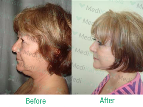 facelift facelift