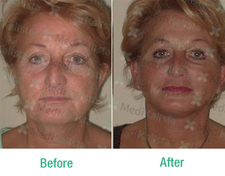 facelift facelift