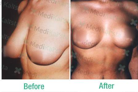 breast lift with implants breast lift with implants