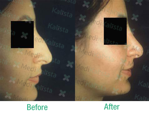nose surgery nose surgery