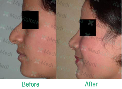 nose surgery nose surgery