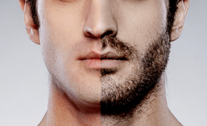 greffe de barbe