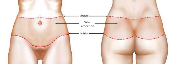 bodylift_scras
