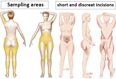 lipofilling corps lipofilling corps