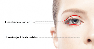 blépharoplastie blépharoplastie