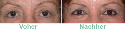blépharoplastie blépharoplastie